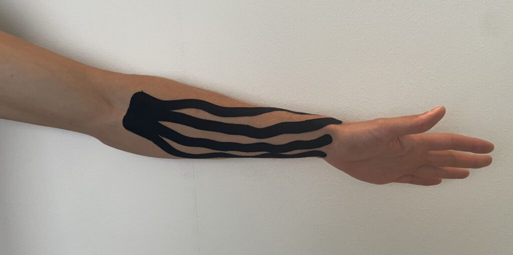 Taping erklärt: Wann es eingesetzt wird und was man wissen sollte 2 ein ausgestreckter Arm mit schwarzem Kineasiotape