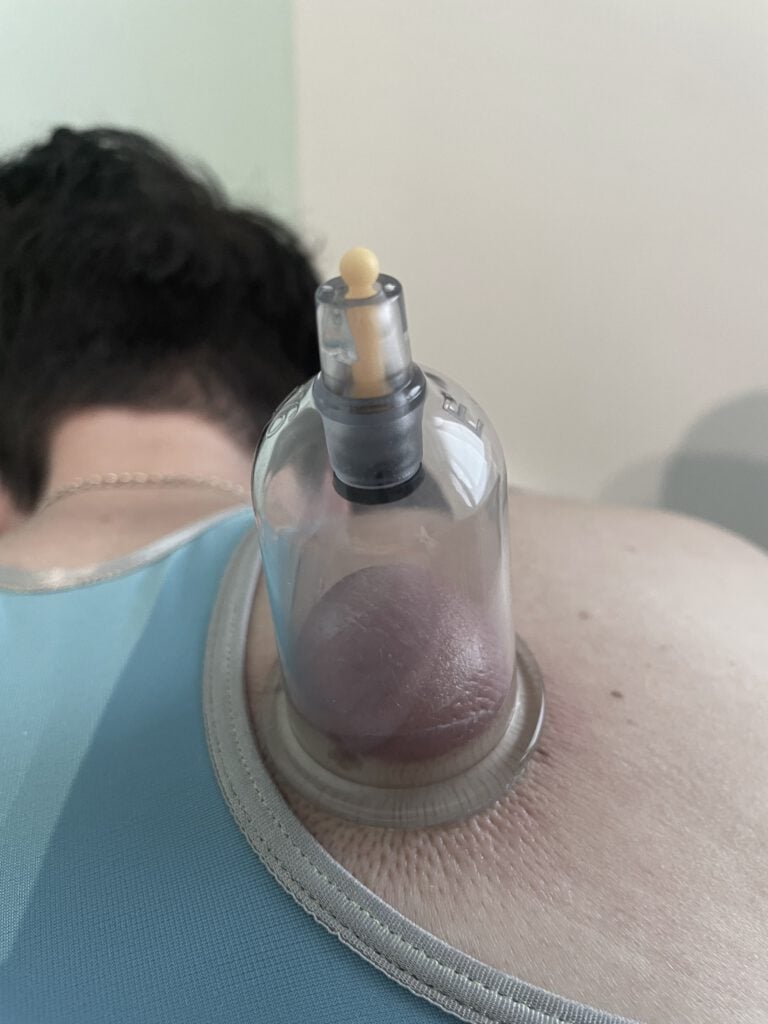 Schröpfen: Zwischen Tradition und moderner Therapie – Wirkung, Methoden und Einsatzmöglichkeiten 2 Schroepfen Blog 2